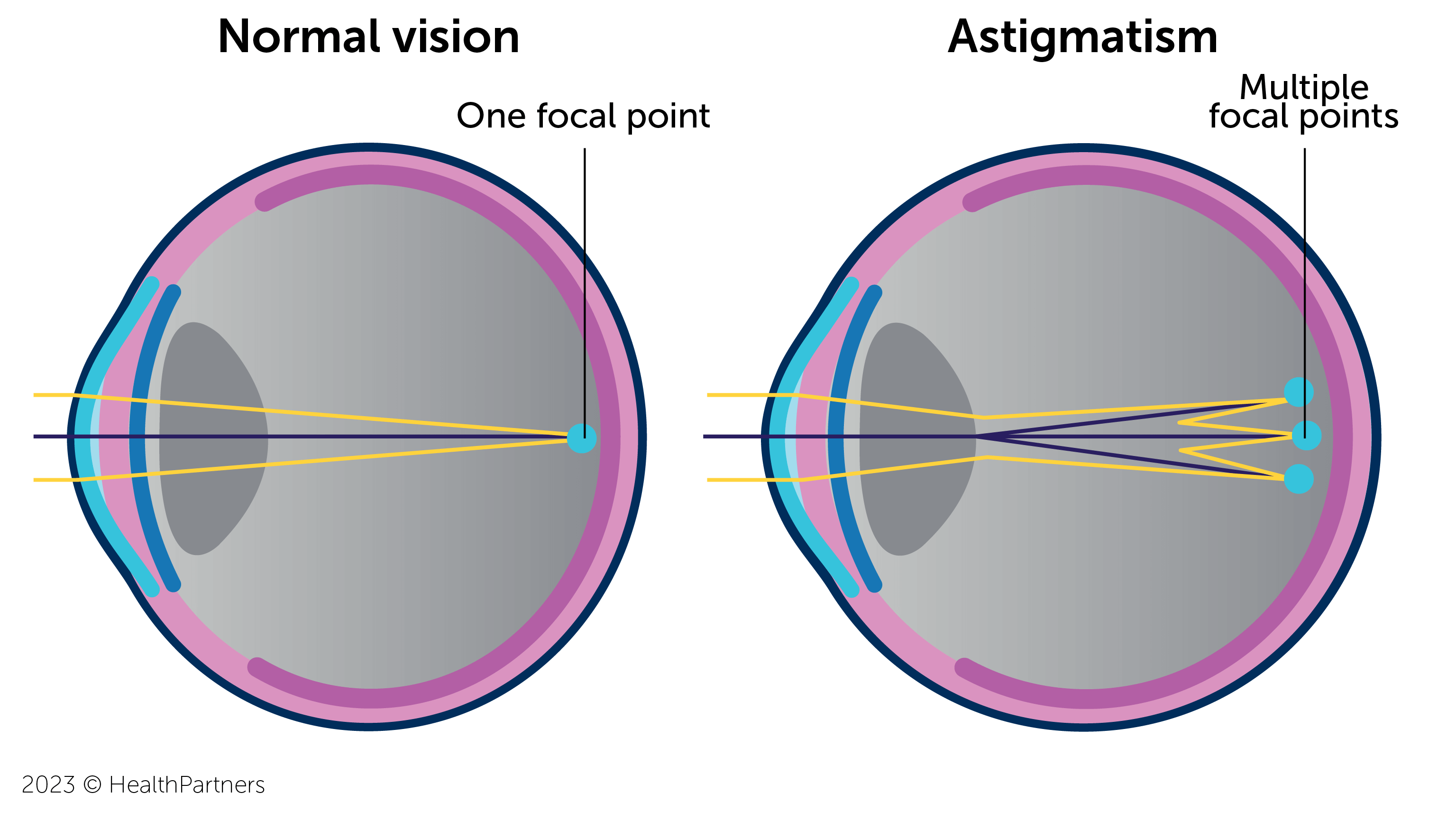 Astigmatism Due To Eye Shape