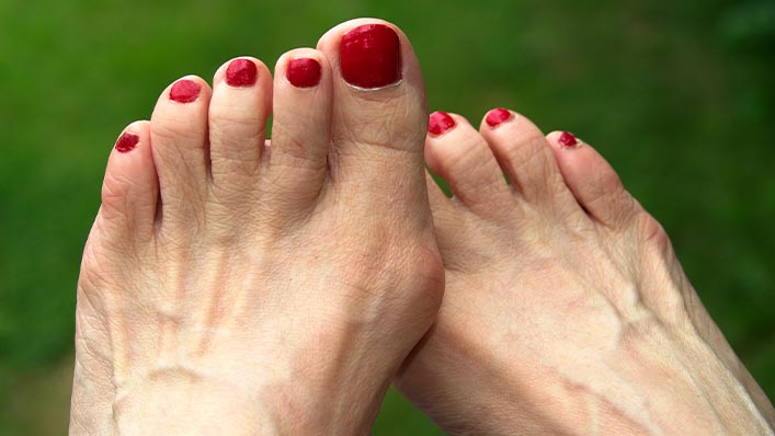 A close-up of a woman's feet with a bunion developing on the joint of her big toe.