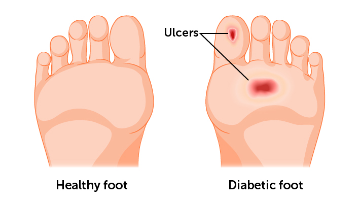 A diagram of a healthy foot and a foot with diabetic foot ulcers