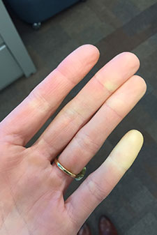 Symptoms of Raynaud’s include fingers that turn white or blue due to cold or stress