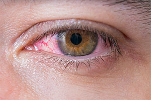 Close up of a man's blood-shot, irritated eye.